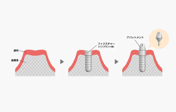 インプラント埋入手術（日帰り）