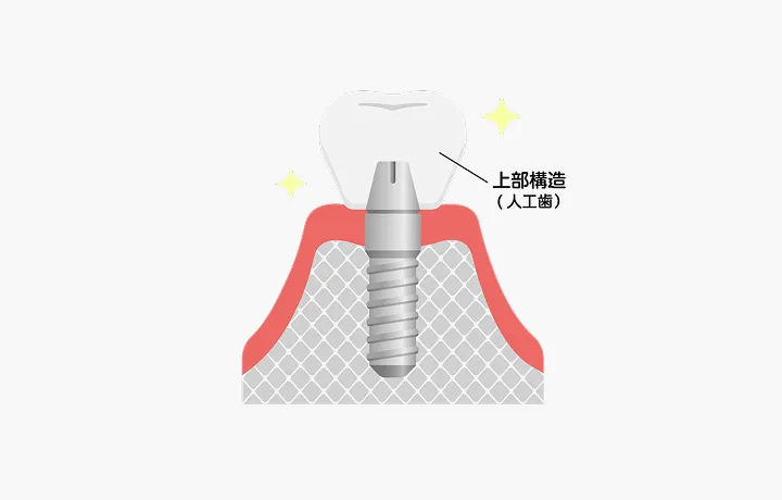 最終補綴物（人工歯）の装着