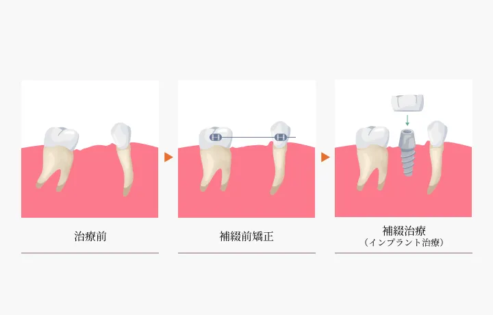 インプラント治療を見据えた歯列矯正（補綴前矯正）
