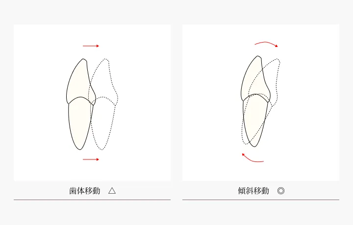 マウスピース矯正の適応