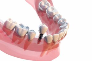 インプラントオーバーデンチャーのメリットや通常の治療との違いを解説