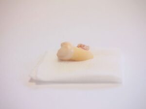 すぐに受診！抜けた歯の応急処置と保存法