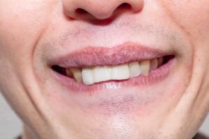 インプラント治療中に装着する仮歯の費用や期間と注意点