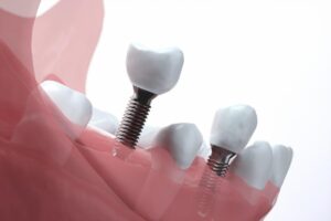 インプラント治療の流れと期間を徹底解説！手術から完了までのステップ