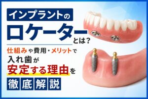 インプラントのロケーターとは？仕組みや費用・メリットで入れ歯が安定する理由を徹底解説